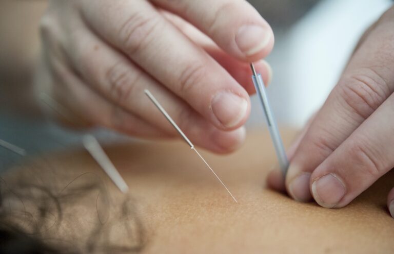 Acupuncture: Everything You Should Know Before Trying