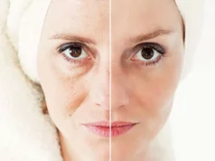 Non-Surgical Face Skin Tightening