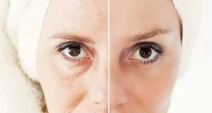 Non-Surgical Face Skin Tightening